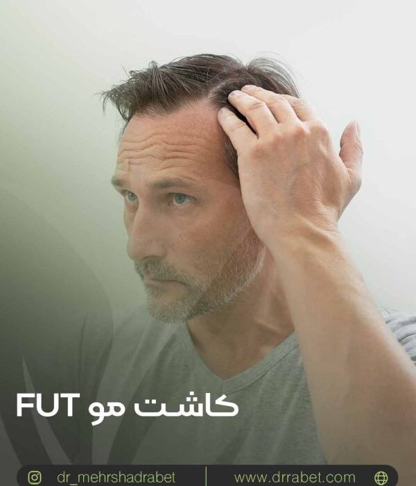 انواع روش های کاشت مو از fut تا fit
