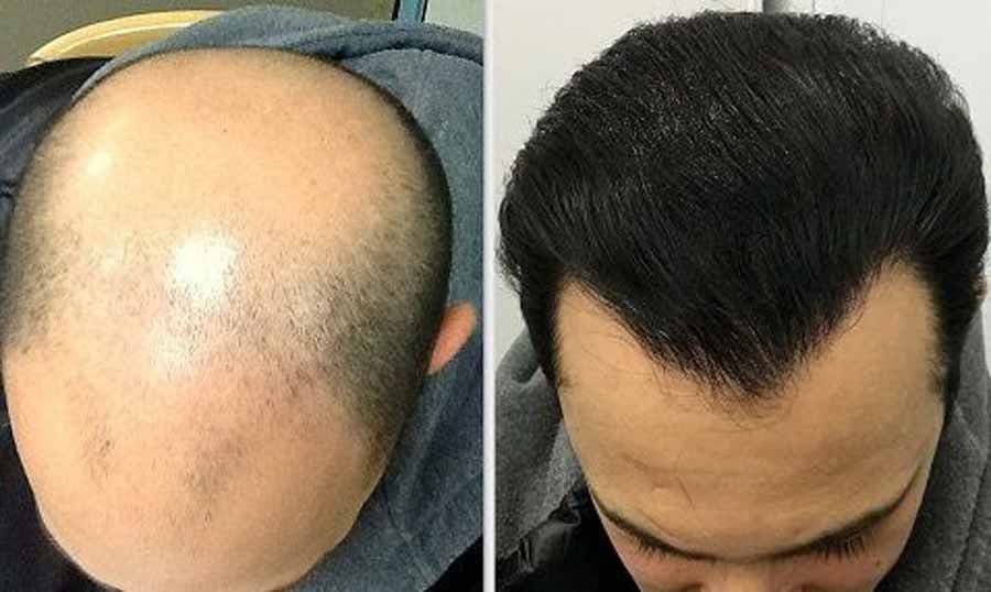انواع روش های کاشت مو