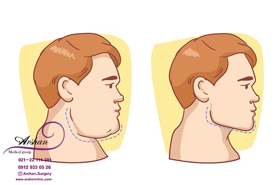جراحی تخلیه چربی بوکال یا بوکال فت Buccal Fat چیست؟