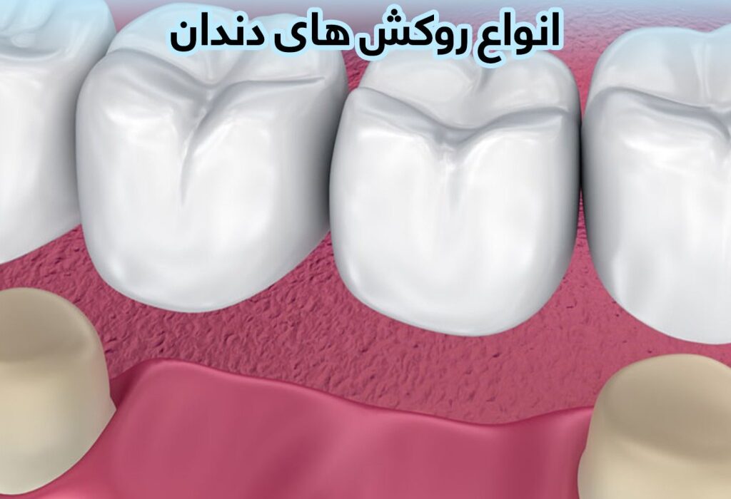 چرا دندان زیر روکش درد میگیرد؟