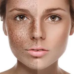 بهترین داروها برای از بین بردن لک صورت چیست؟
